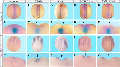 Alcohol induces neural tube defects by reducing retinoic acid signaling and promoting neural plate expansion
